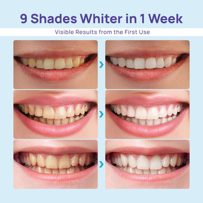 Whitebite Pro Teeth Whitening Kit | Safe for Sensitive Teeth | 32X LED Light, 3 Whitening Pens & 1 Remineralizing | Pen Powerful Tooth Stain Remover