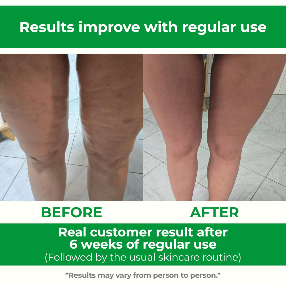 TESMED Cellulite Manual Massager : Made in Italy, Patented with Converging & Diverging Roller Technology. Anti Cellulite Roller for Thighs and Buttock