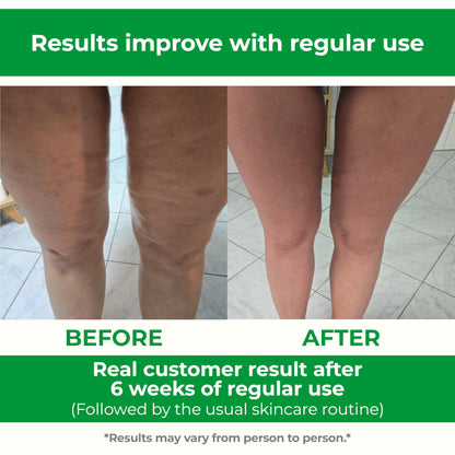 TESMED Cellulite Manual Massager : Made in Italy, Patented with Converging & Diverging Roller Technology. Anti Cellulite Roller for Thighs and Buttock